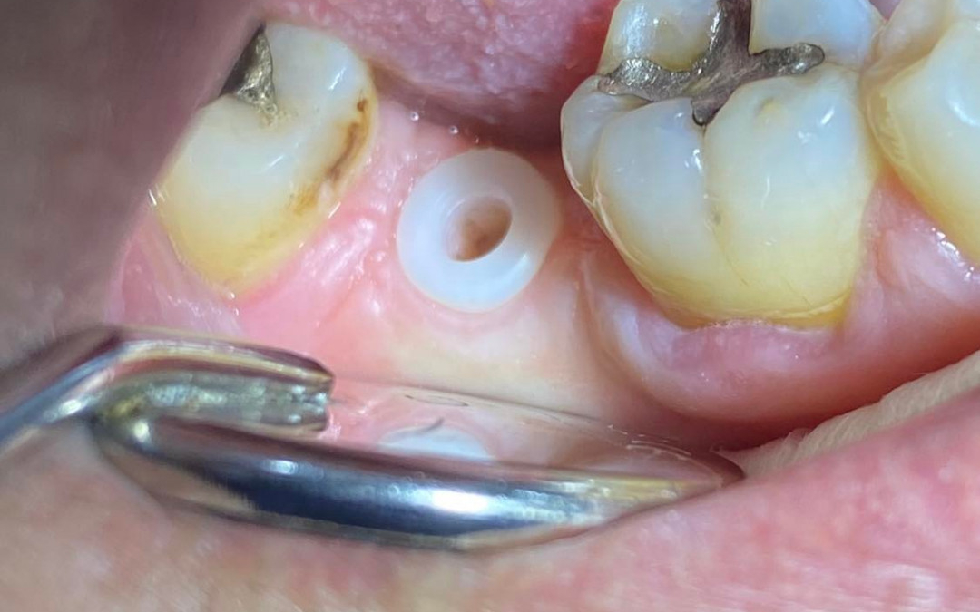 Replacement of lower right second molar with a ceramic implant